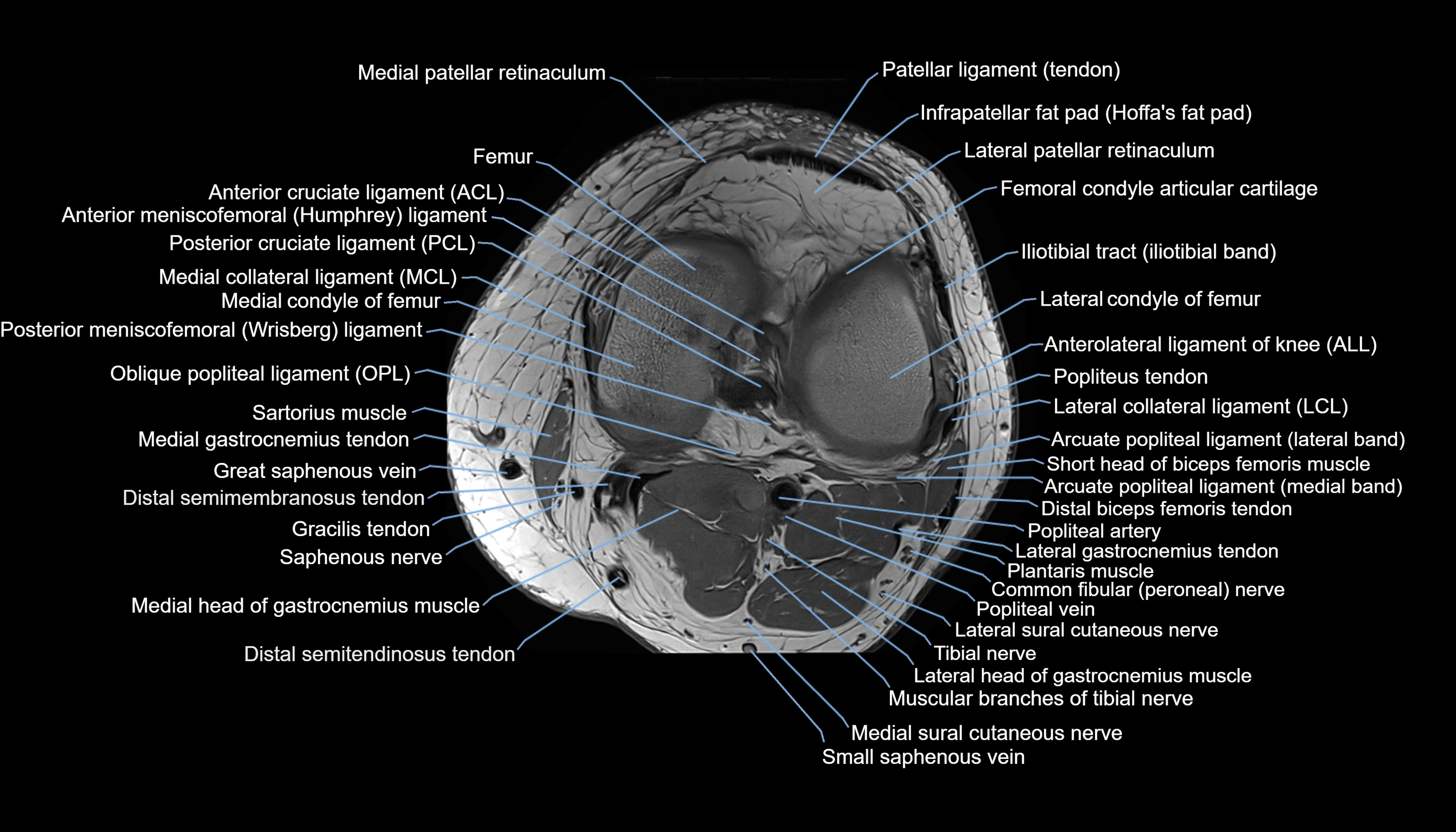 MRI knee  axial cross sectional anatomy 3T radiology  image-img-00001-00027.webp